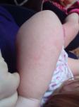 Сыпь с воспалением по всему телу ребёнка фото 2