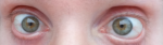 Уже больше 6 месяцев глаза красные, очертания красноты не меняются фото 1