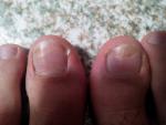 Изменение ногтя большого пальца ноги фото 1