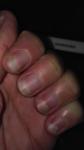 Псориаз ногтей фото 1