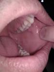 Мелкие прыщики на щеках, следы зубов на языке фото 4