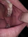 Мелкие прыщики на щеках, следы зубов на языке фото 2