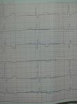 Инфаркт миокарда на ногах, расшифровка ЭКГ фото 1