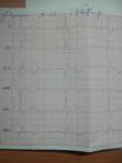 Инфаркт миокарда на ногах, расшифровка ЭКГ фото 2