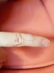 Шишка на пальце во время беременности фото 1