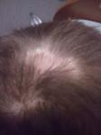 Гнойный прыщи, выпадение волос, чесотка фото 1
