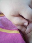 Сыпь у ребенка на пальцах рук и ног фото 2