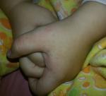 Сыпь у ребенка двух лет фото 3