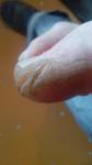 Трещины на пальце ноги фото 1
