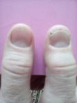 Укорочение ногтя, трещины на коже у ногтя фото 1