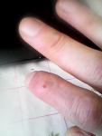 Высох палец после раны фото 2
