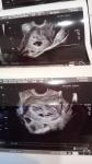 Расшифровка результата ультразвукового сканирования беременности малого срока фото 4