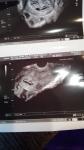 Расшифровка результата ультразвукового сканирования беременности малого срока фото 5