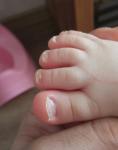 Грибок ногтей у ребенка фото 1