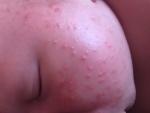 Аллергическая сыпь ли это? фото 3