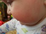 Диатез на щеках у ребенка 10 мес фото 2