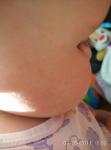 Диатез на щеках у ребенка 10 мес фото 1