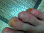 Грибок ногтей ног фото 3