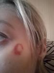 Ожог на лице после микодерила фото 1