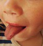 Пятно на языке и герпес на губе у ребенка на фоне ОРВИ фото 1