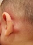 Шишка НАД ухом и ЗА ухом у ребенка. Что это? фото 1