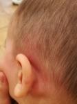 Шишка НАД ухом и ЗА ухом у ребенка. Что это? фото 3