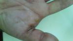 Опухоль после глубокого пореза травой ладони в р-не большого пальца фото 2