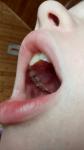 Воспаление десны возле запломированого зуба фото 3