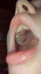 Воспаление десны возле запломированого зуба фото 1