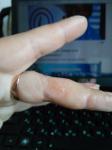 Сыпь водянистая на внутренней стороне пальцев рук и зуд фото 1