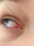 Воспаление внутреннего уголка глаза фото 1