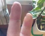 Боль в суставах пальцев после травмы- срезал мочку на пальце фото 1
