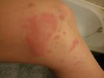Аллергия на локтях и коленях фото 2
