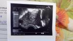 Долгая коричневая мазня при ранней беременности фото 1