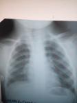 Расшифровка рентгена грудной клетки ребенка фото 1