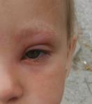 Оса укусила в глаз ребенка фото 1
