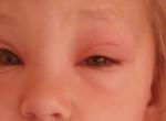 Оса укусила в глаз ребенка фото 2