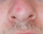Ожог на носу после удаления бородавки фото 1