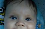 Асимметрия глаз новорожденного фото 1