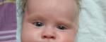 Асимметрия глаз новорожденного фото 2