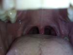Лимфаденопатия, красное горло фото 6
