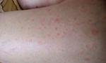 Странная сыпь на теле, подозрение на вирус Коксаки фото 3
