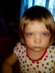 У ребенка появилось покраснения под глазками при прикосновении немного болит фото 1
