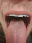Воспаление под языком фото 5
