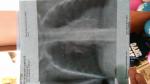 Затяжной кашель у ребёнка, рентген исследование фото 2