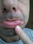 На слизистой нижней губы образование фото 2