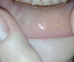 Белая полоса на внутренней стороне нижней-губы фото 1