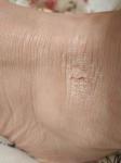 Сухое уплотнение с трещиной на коже ноги фото 2
