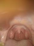 Дискомфорт в горле, пупырышки на задней стенки горло фото 1