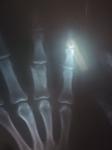 Перелом пястной кости 4 пальца правой кисти фото 2